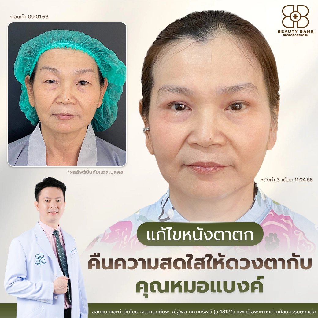 แก้ไขหนังตาตก