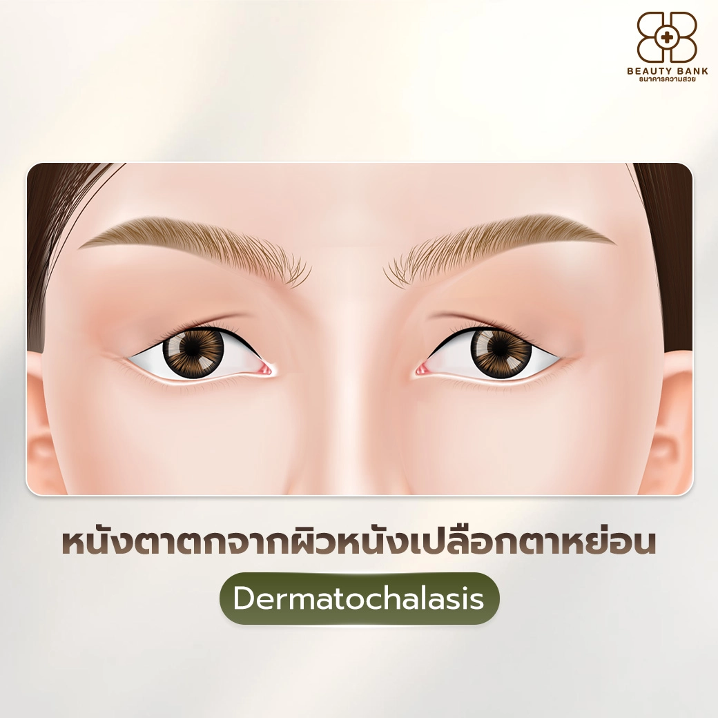 หนังเปลือกตาหย่อน