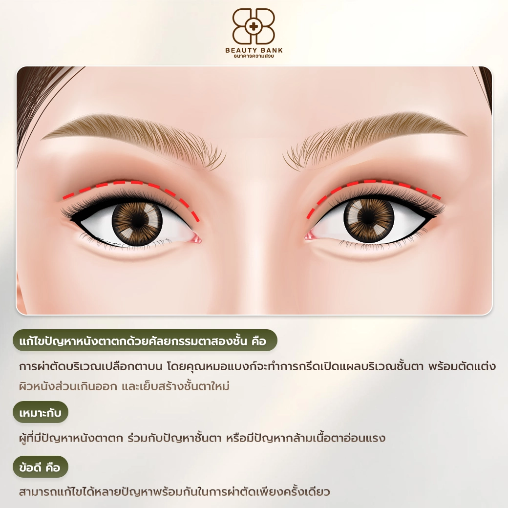 แก้หนังตาตกด้วยการทำตาสองชั้น