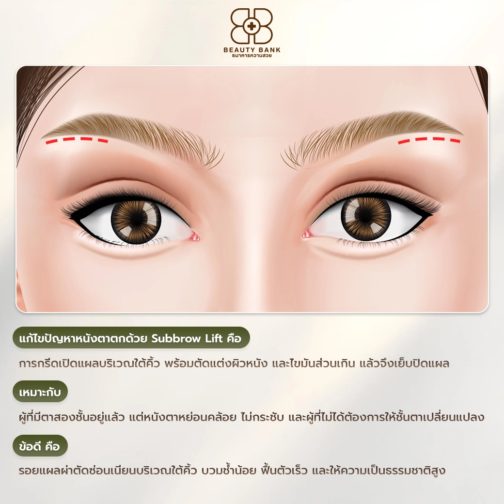 Subbrow Lift