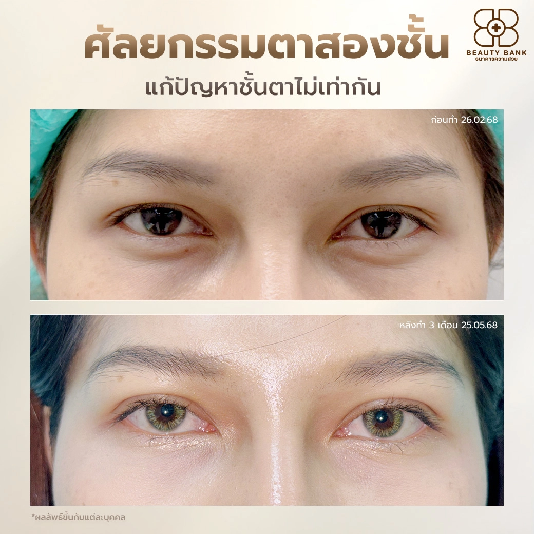 รีวิวตาสองชั้นสวย