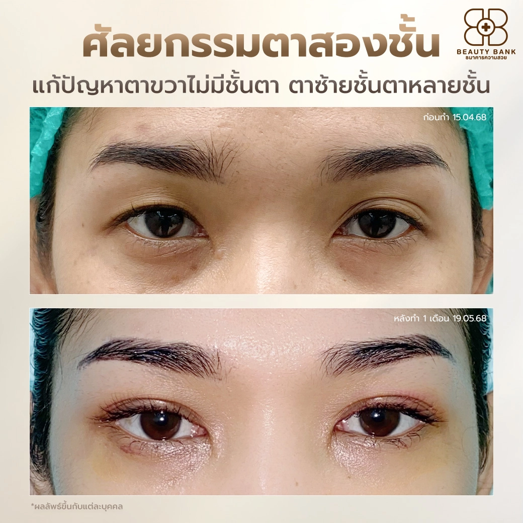 รีวิวตาสองชั้น แก้ชั้นตาไม่เท่ากัน