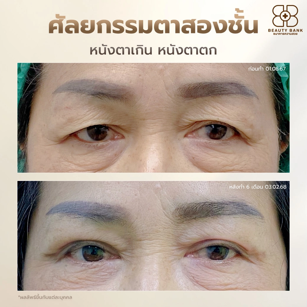 ทำตาสองชั้น แก้ไขหนังตาตก