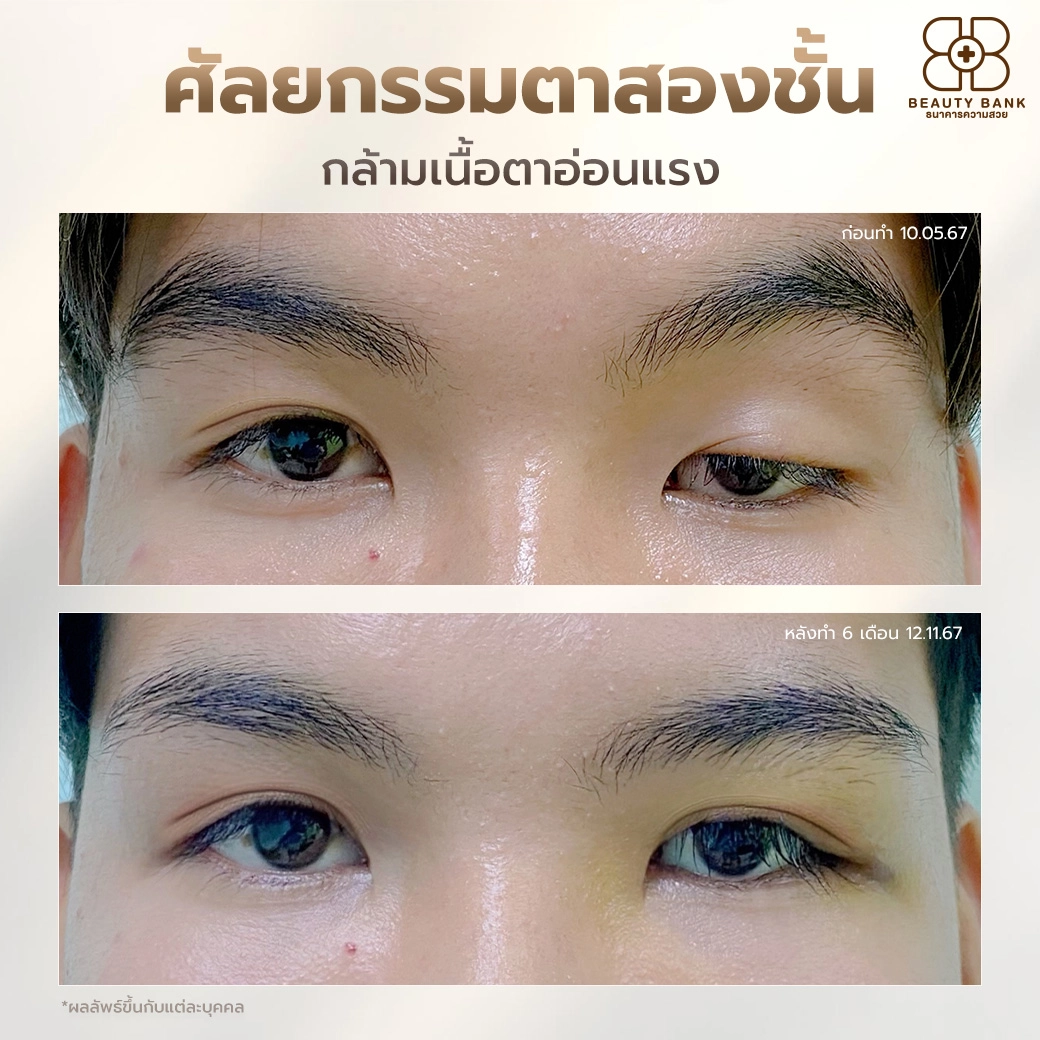 ตาสองชั้นแก้ไขกล้ามเนื้อหาอ่อนแรง