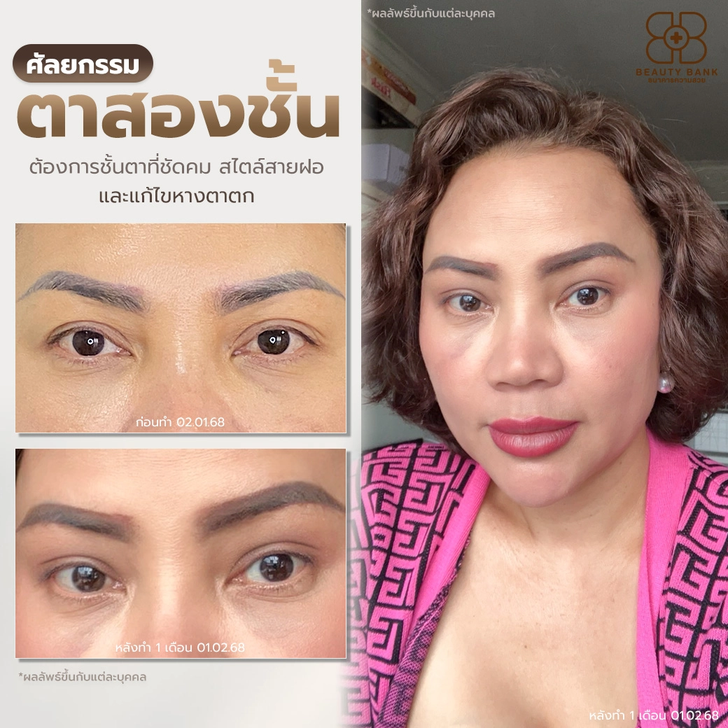 ตาสองชั้นสไตล์สายฝอ