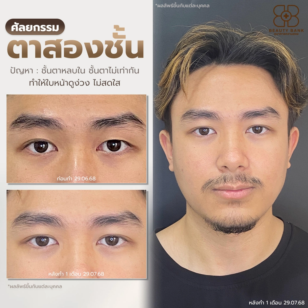 ตาสองชั้นแก้ไขชั้นตาหลบใน หมอเก่ง