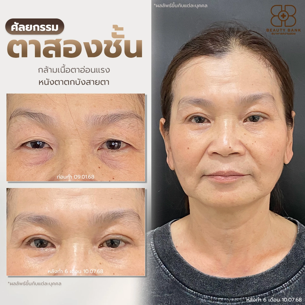 คลินิกรักษากล้ามเนื้อตาอ่อนแรง ตราด