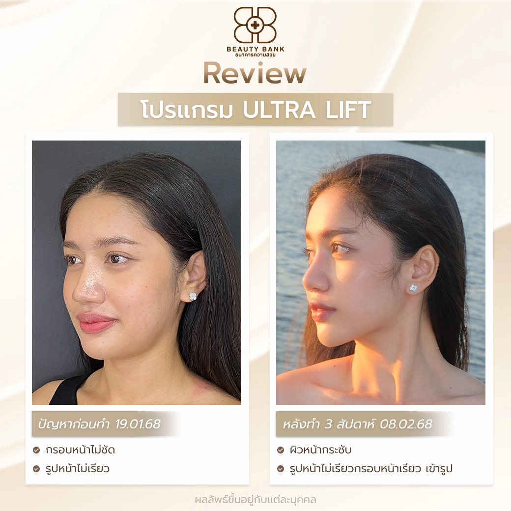 รีวิว Ultra Lift
