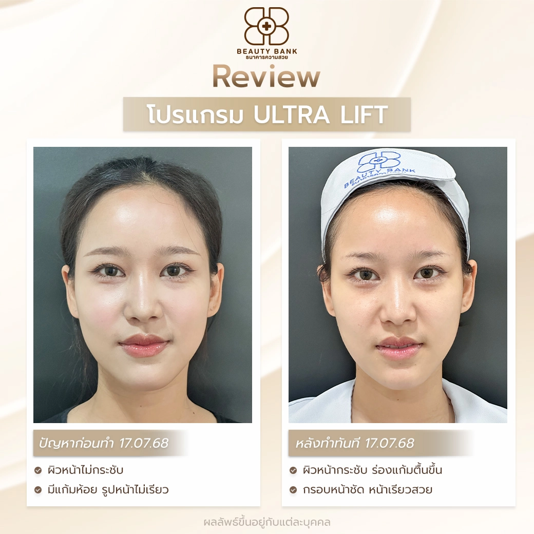 ผลลัพธ์ Ultra Lift