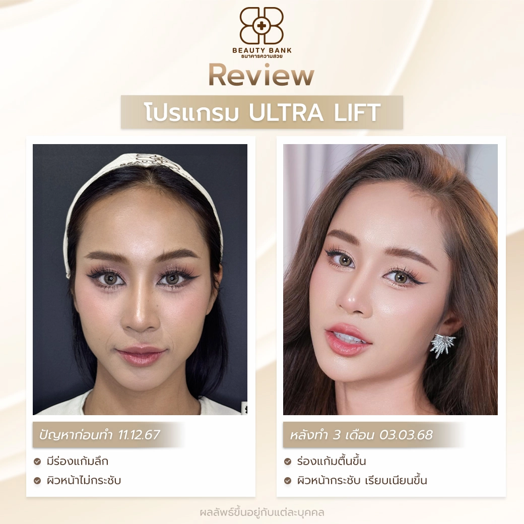 หมอทำ Ultra Lift