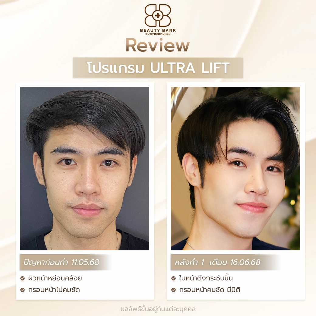 กรอบหน้า V-Shape