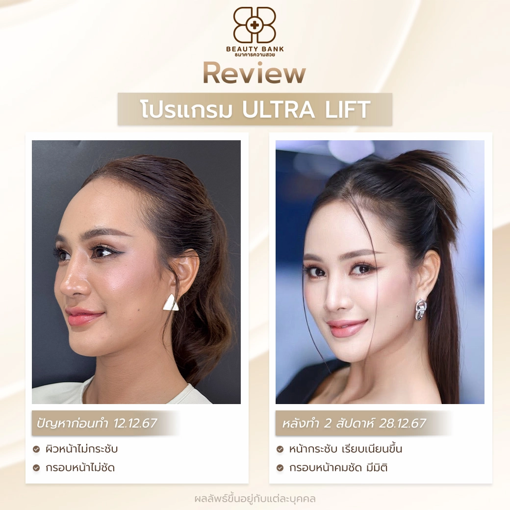 ลดร่องแก้มด้วย Ultra Lift