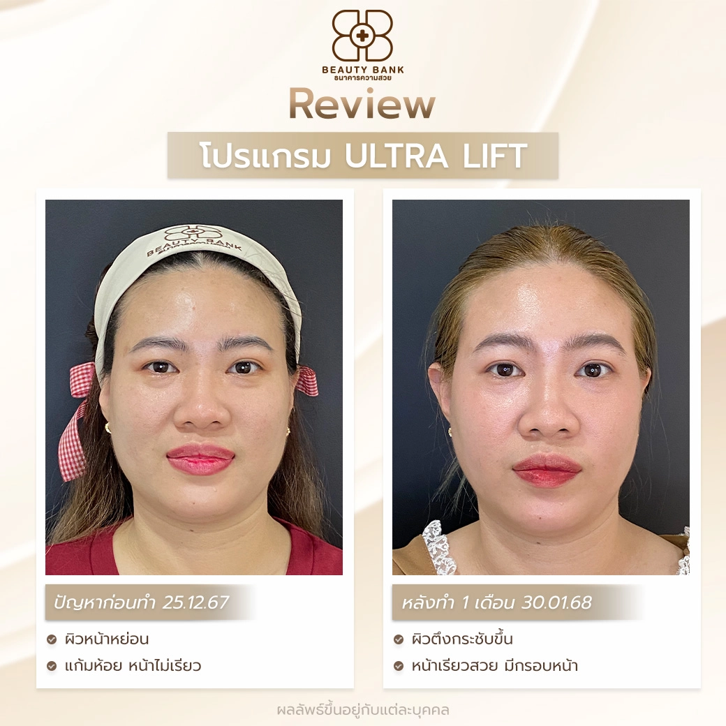 หลังทำ Ultra Lift ทันที