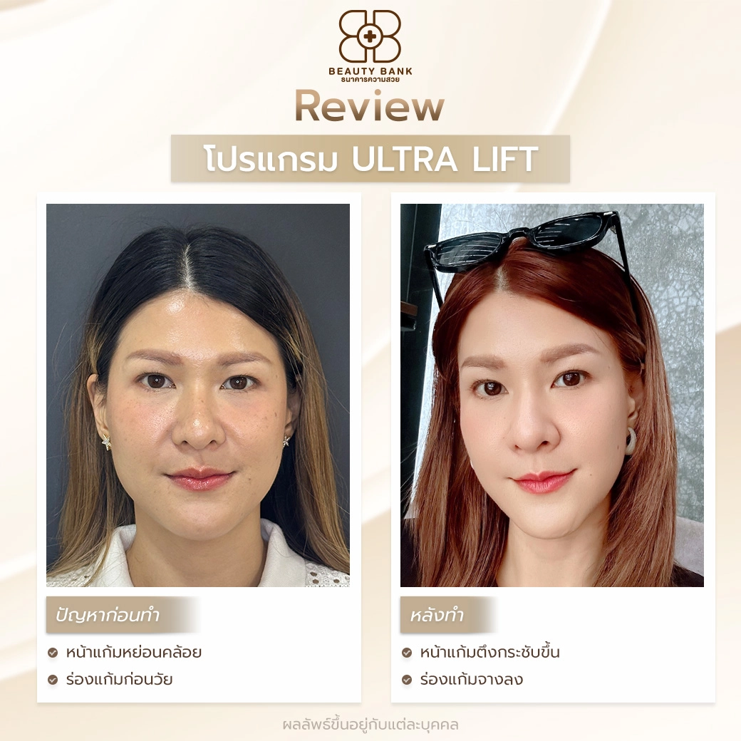 ultra lift ราคา