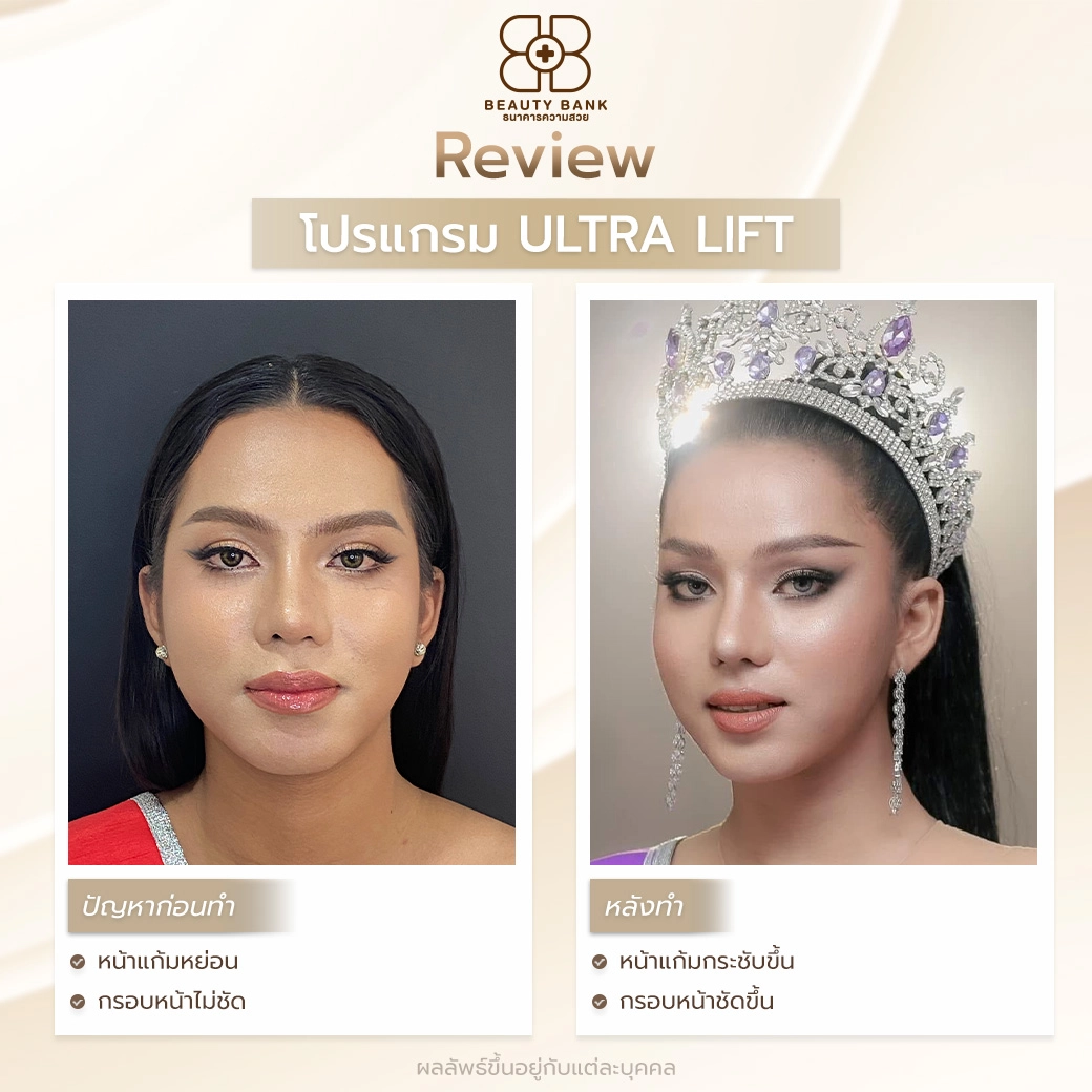 รีวิว ultra lift หมอแบงค์