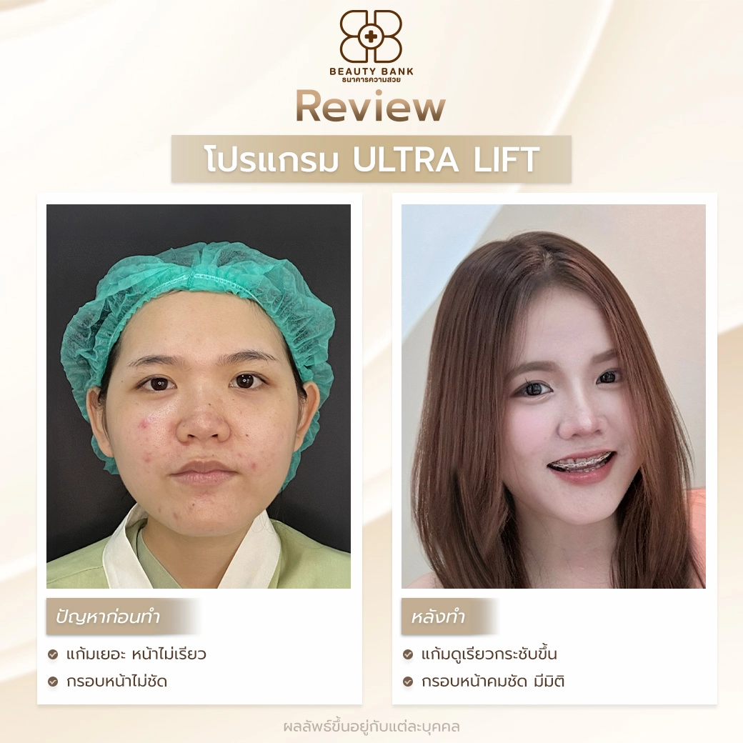 ultra lift ดีไหม