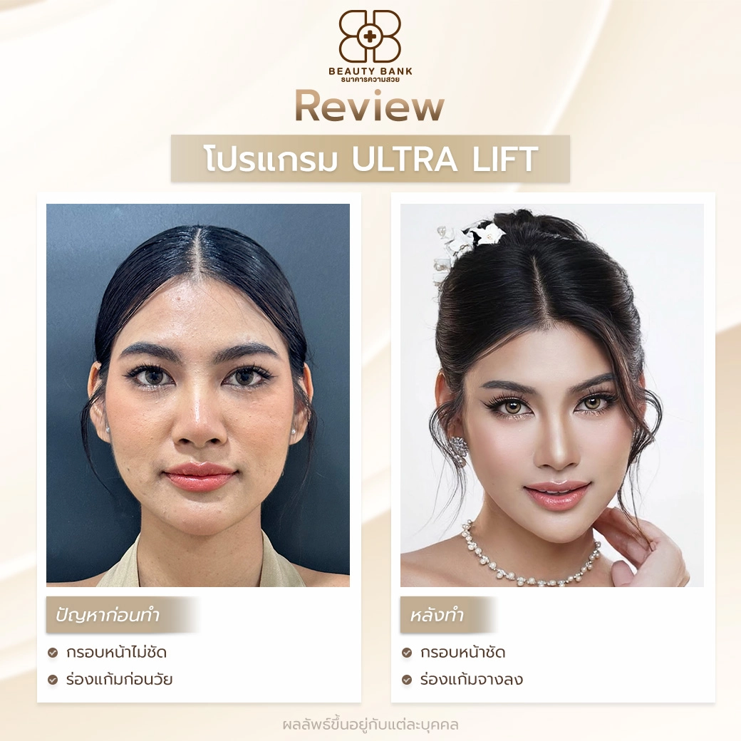 หน้าเด็กด้วย Ultra Lift
