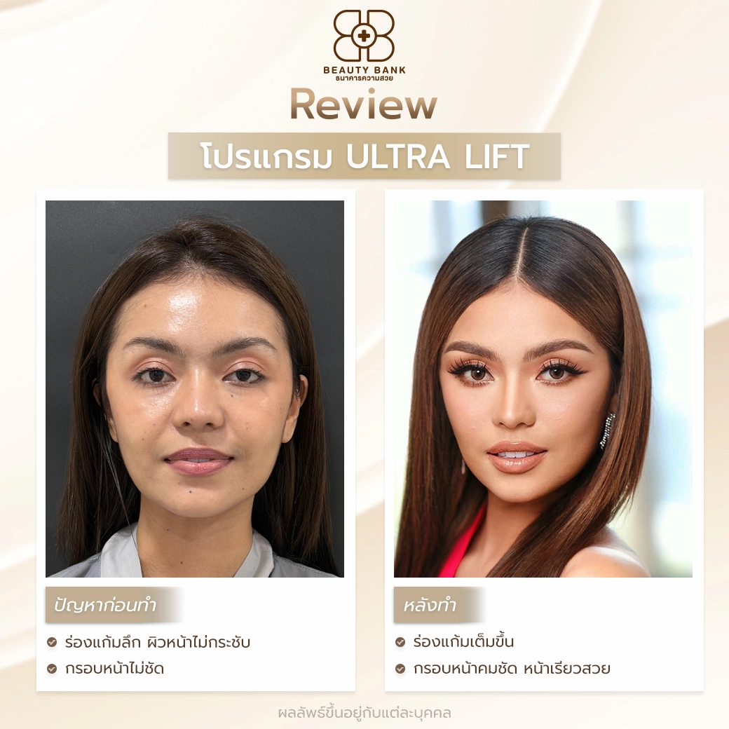 ultra lift ราคาไม่แพง