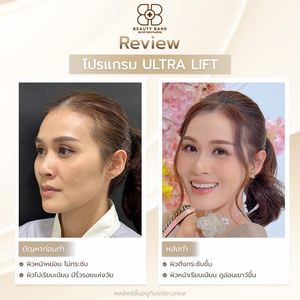 หมอเก่งทำ ultra lift